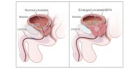 Which Treatment is Best for Enlarged Prostate?